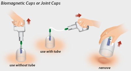 vacuum-cupping-L.jpg